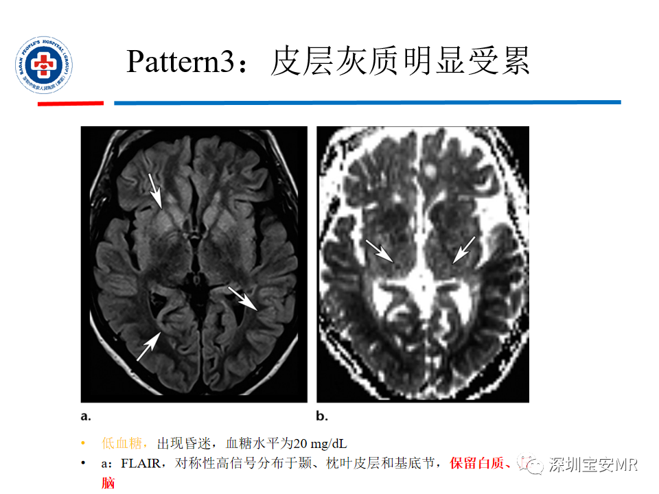 影像PPT - 【PPT】中毒性和代谢性脑病的影像模式-26