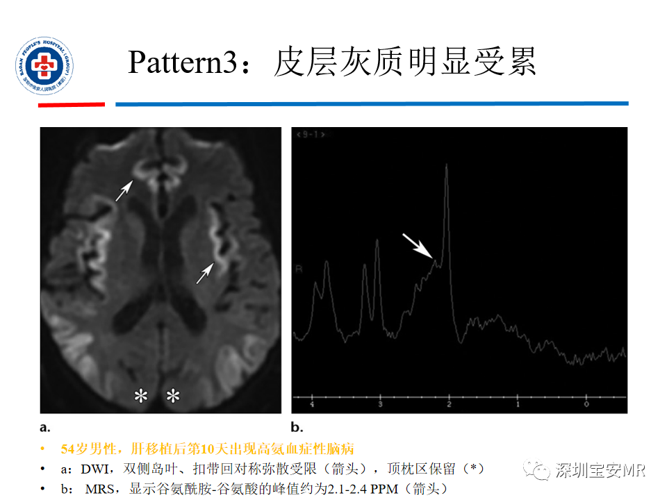 影像PPT - 【PPT】中毒性和代谢性脑病的影像模式-28