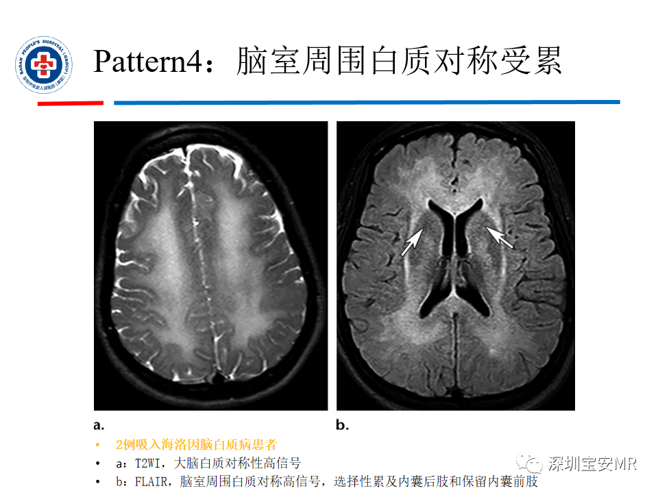 影像PPT - 【PPT】中毒性和代谢性脑病的影像模式-30