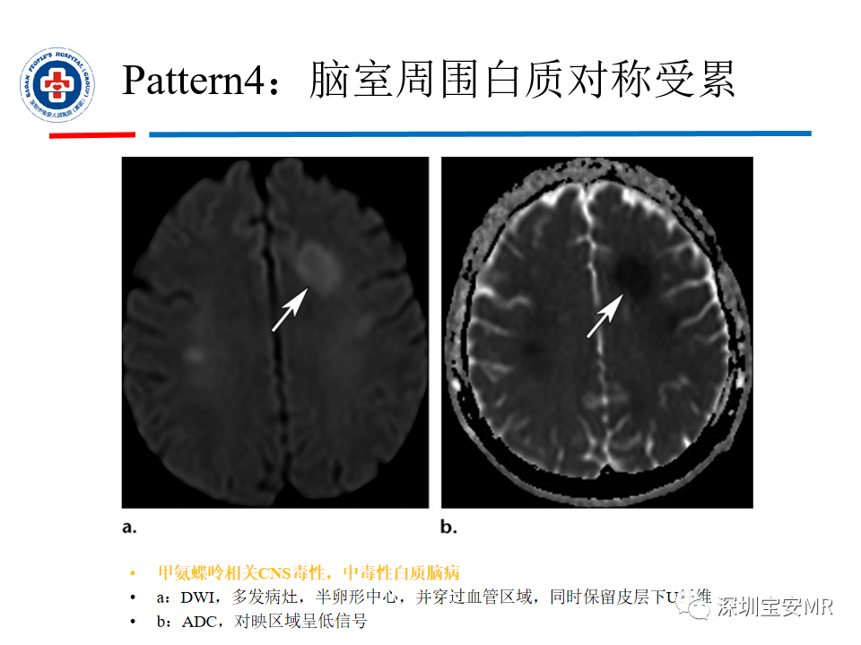 影像PPT - 【PPT】中毒性和代谢性脑病的影像模式-32