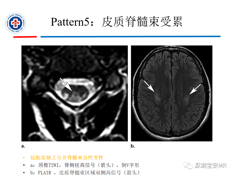 影像PPT - 【PPT】中毒性和代谢性脑病的影像模式-34