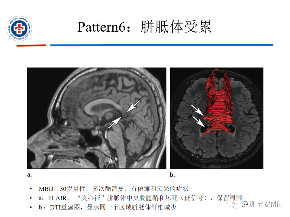 影像PPT - 【PPT】中毒性和代谢性脑病的影像模式-36