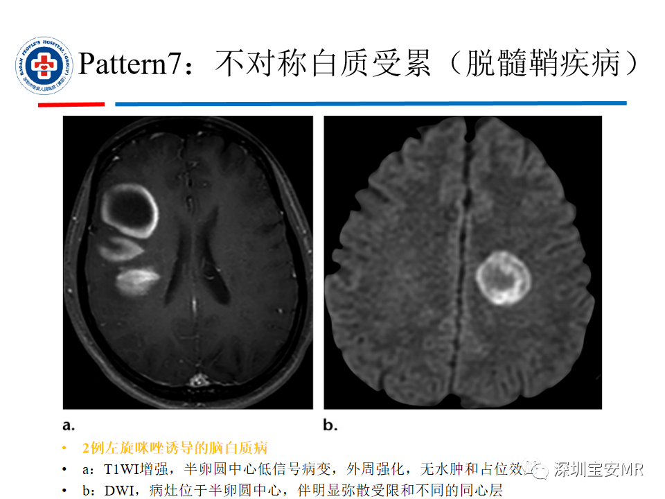 影像PPT - 【PPT】中毒性和代谢性脑病的影像模式-38