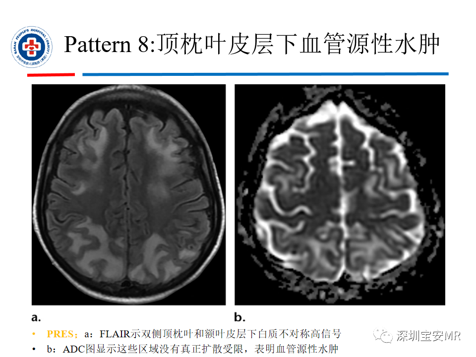 影像PPT - 【PPT】中毒性和代谢性脑病的影像模式-40