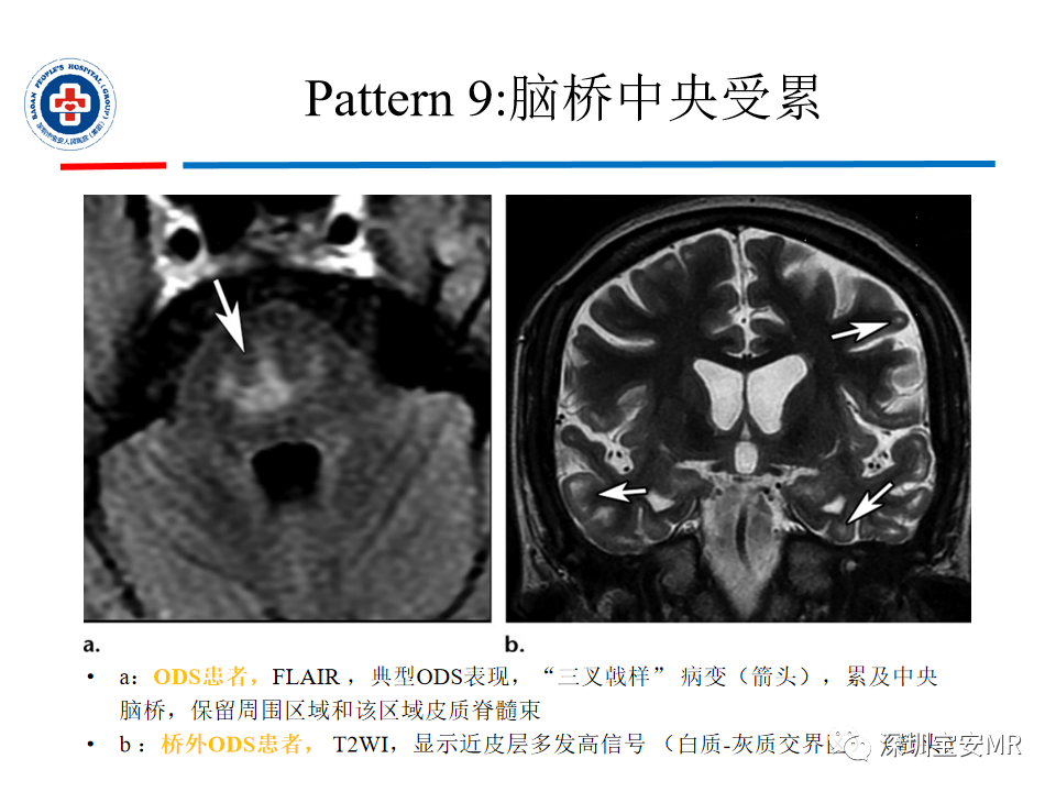影像PPT - 【PPT】中毒性和代谢性脑病的影像模式-42