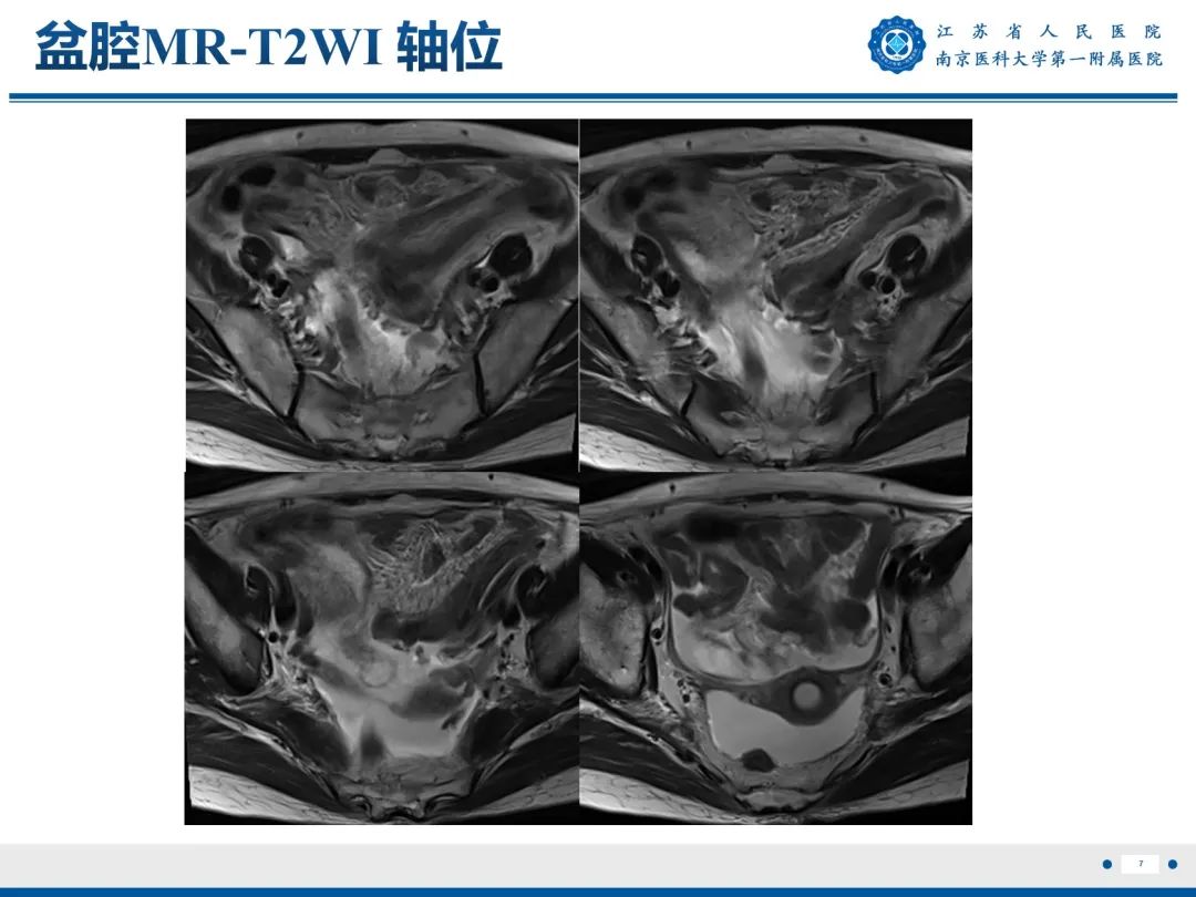 影像PPT - 【PPT】输卵管结核-8
