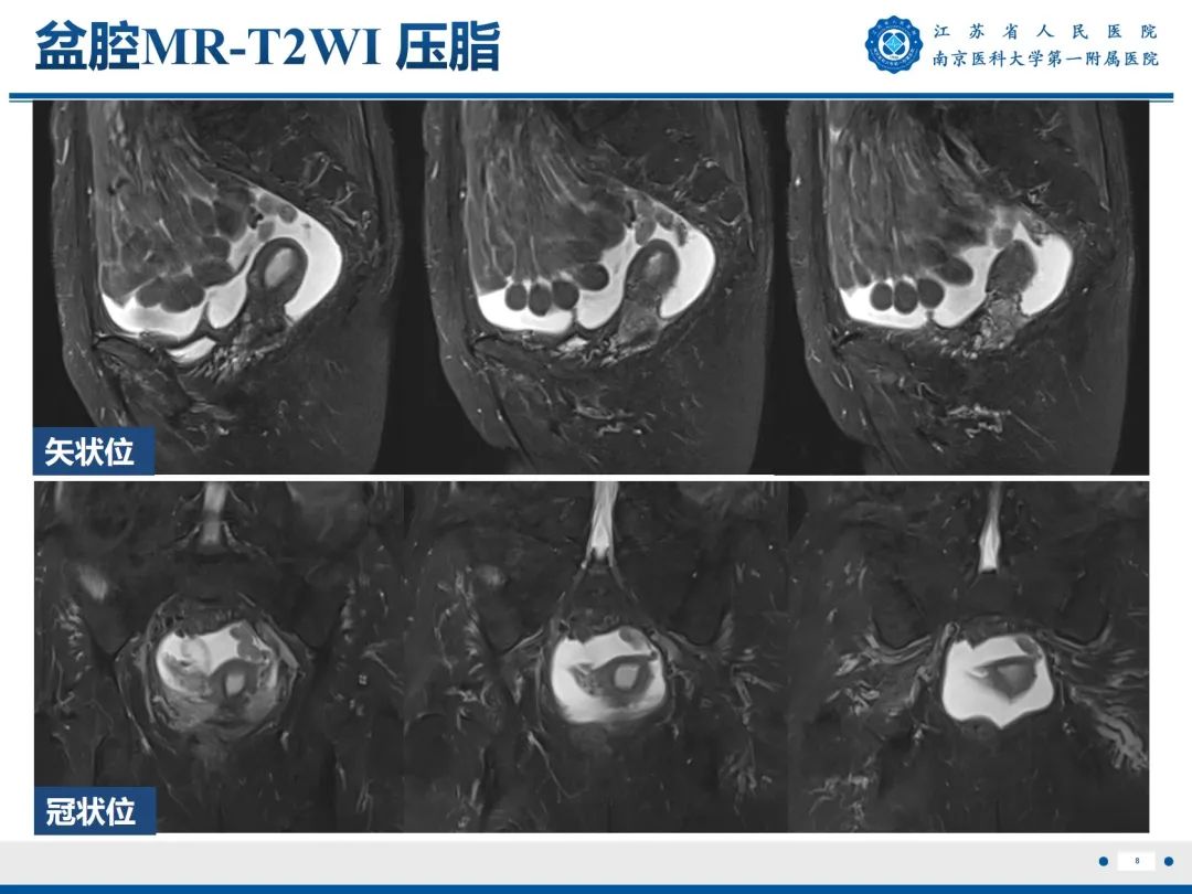 影像PPT - 【PPT】输卵管结核-9
