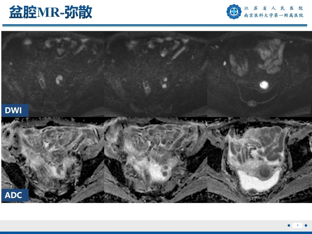 影像PPT - 【PPT】输卵管结核-10