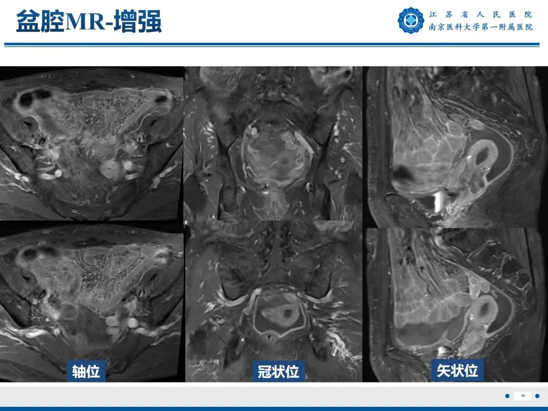 影像PPT - 【PPT】输卵管结核-11