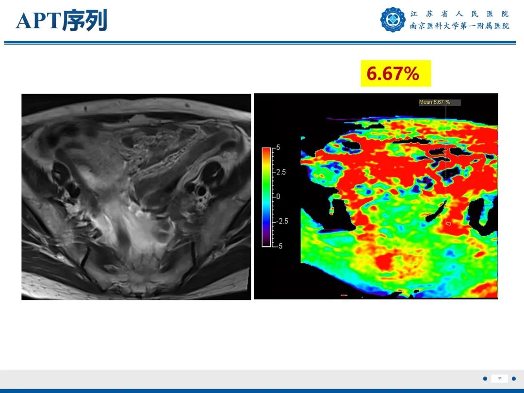 影像PPT - 【PPT】输卵管结核-12