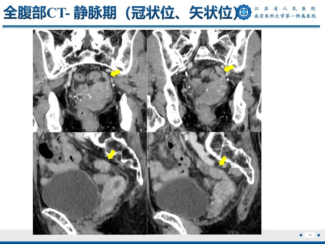 影像PPT - 【PPT】输卵管结核-14