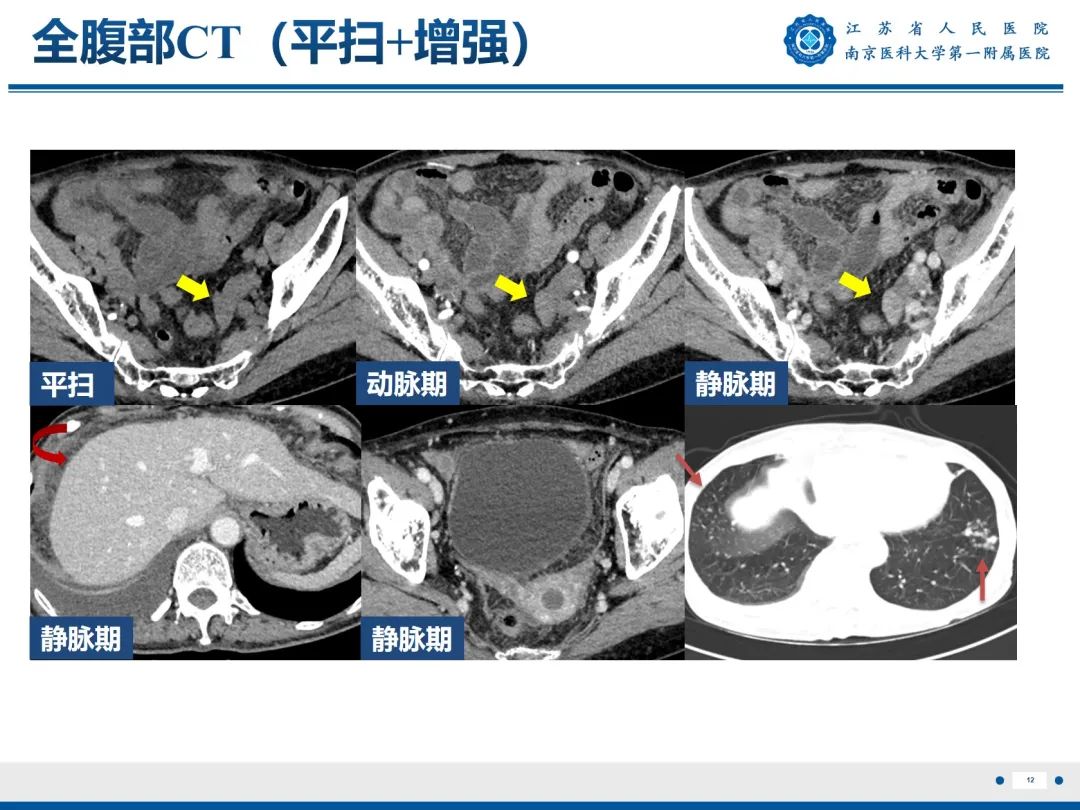 影像PPT - 【PPT】输卵管结核-13