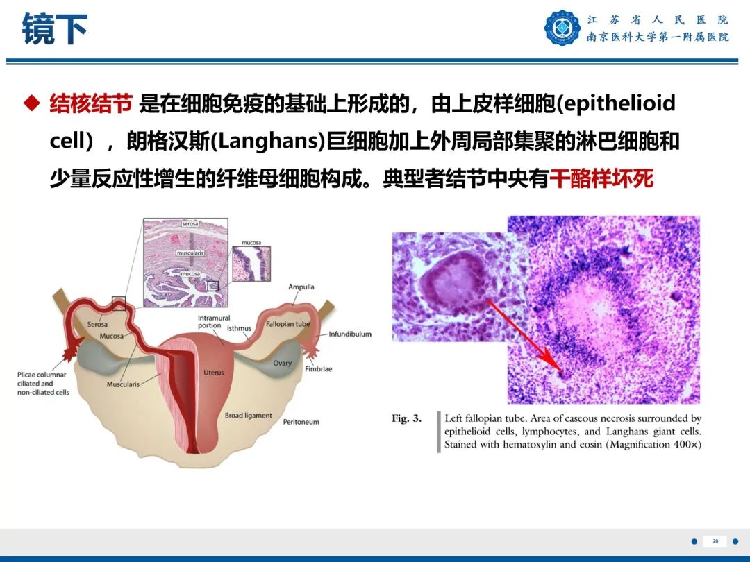 影像PPT - 【PPT】输卵管结核-21