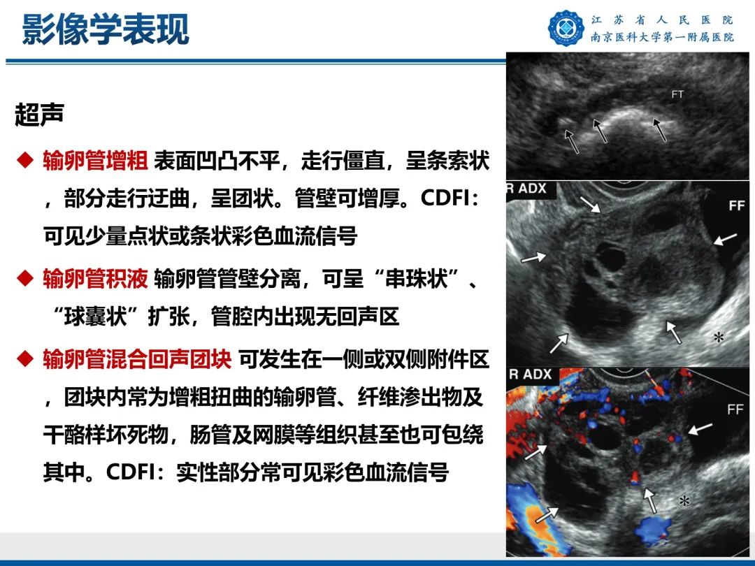影像PPT - 【PPT】输卵管结核-25