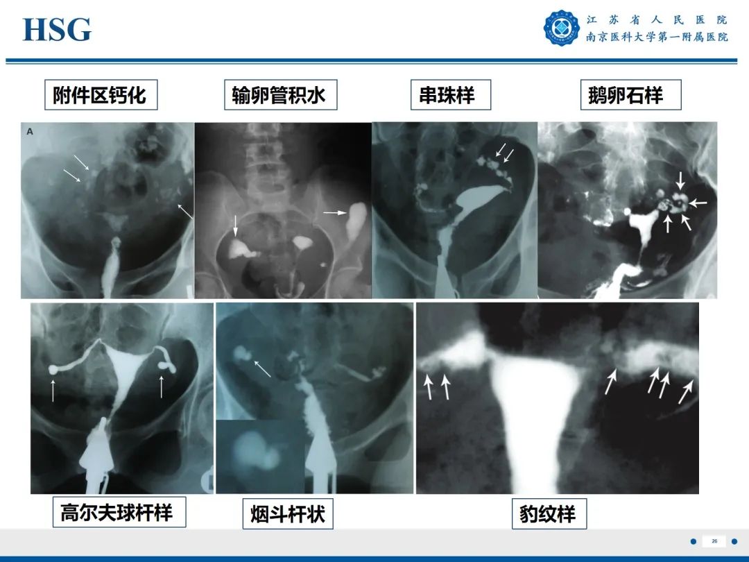 影像PPT - 【PPT】输卵管结核-27