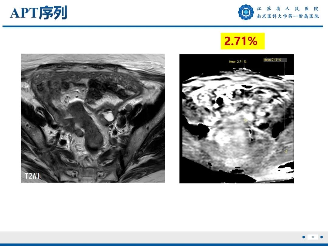 影像PPT - 【PPT】输卵管结核-36
