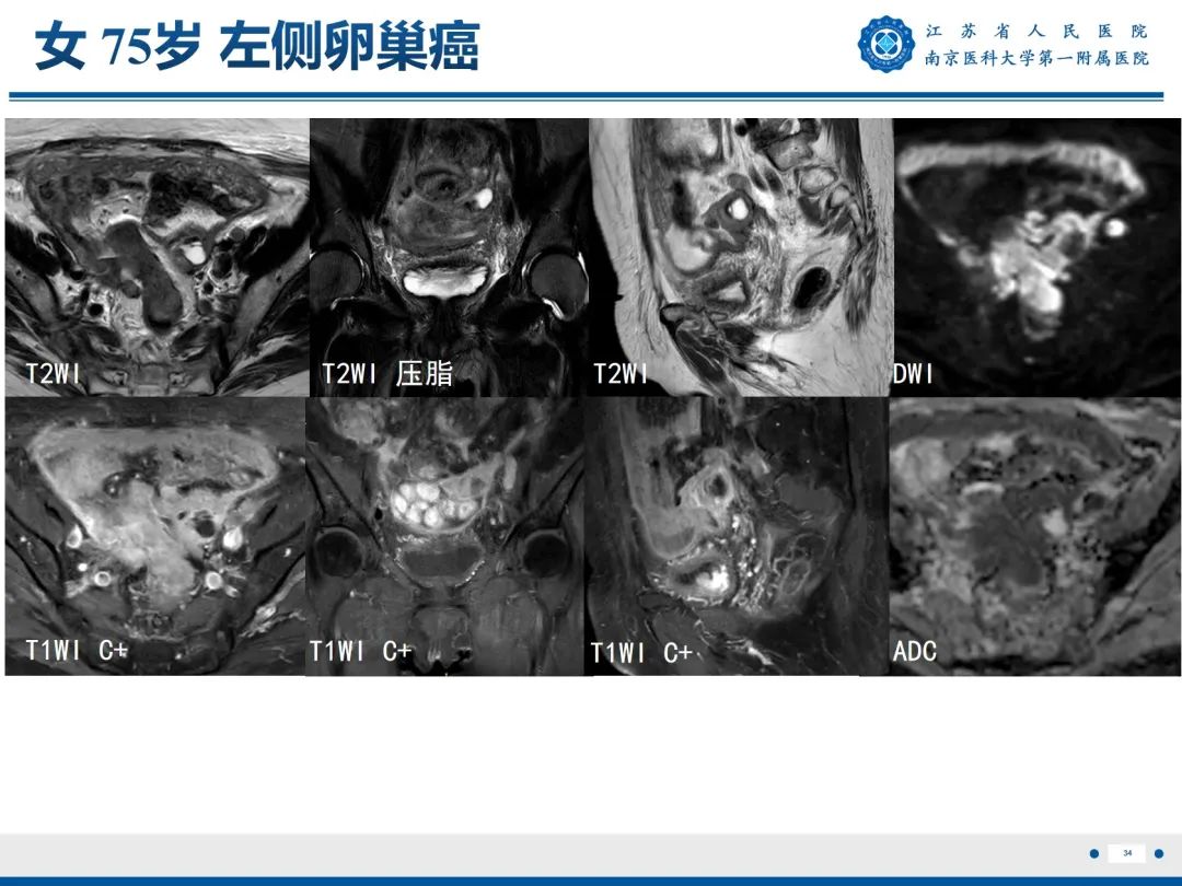 影像PPT - 【PPT】输卵管结核-35