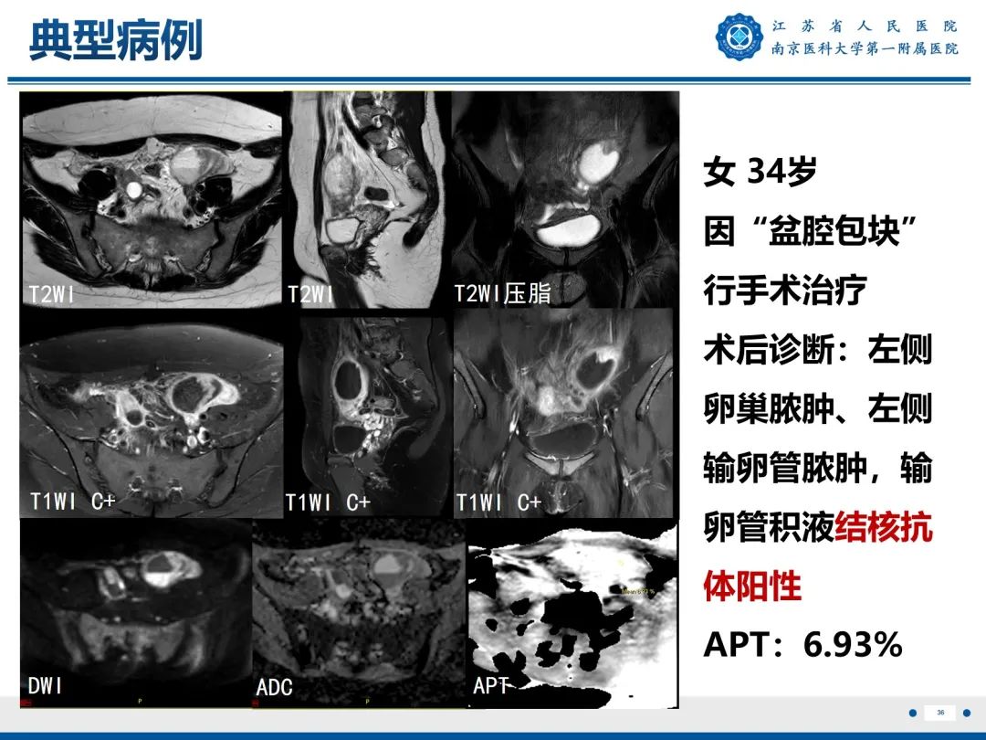 影像PPT - 【PPT】输卵管结核-37