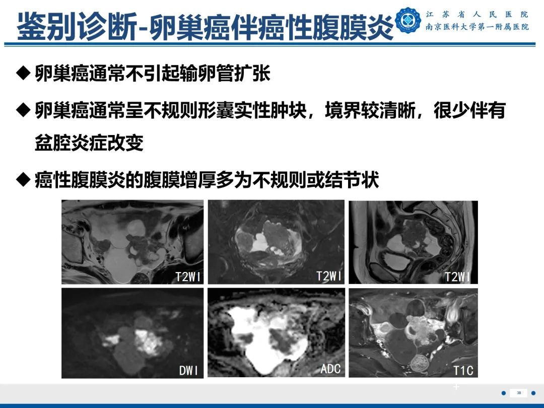 影像PPT - 【PPT】输卵管结核-39