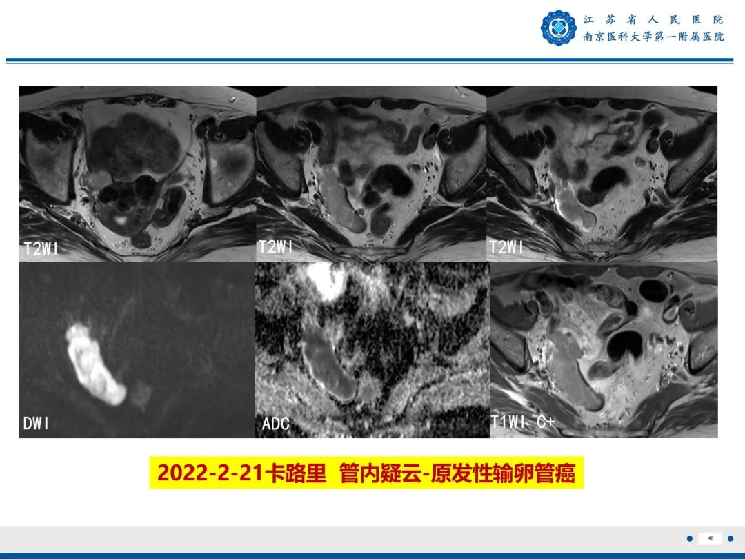 影像PPT - 【PPT】输卵管结核-41