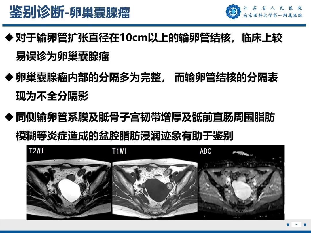 影像PPT - 【PPT】输卵管结核-42