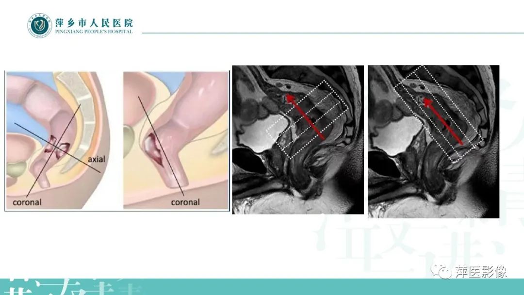 影像PPT - 【PPT】直肠癌MR分期-9