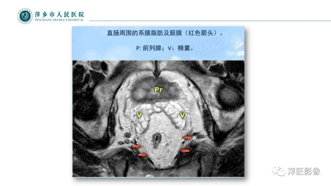 影像PPT - 【PPT】直肠癌MR分期-17