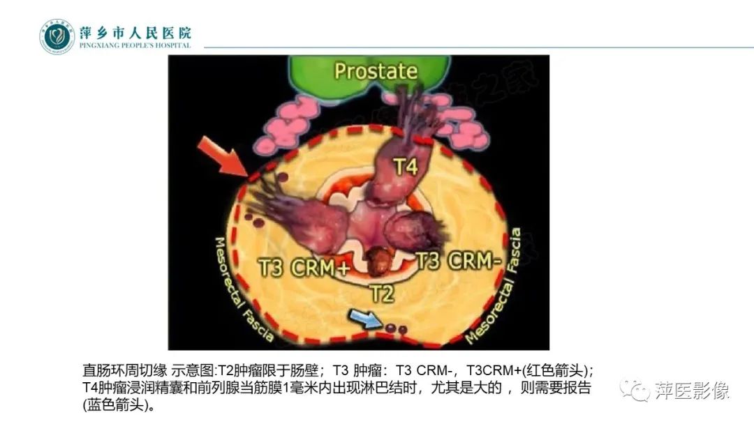 影像PPT - 【PPT】直肠癌MR分期-18