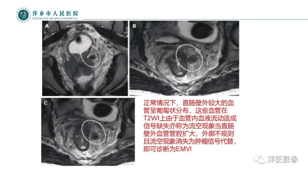 影像PPT - 【PPT】直肠癌MR分期-20