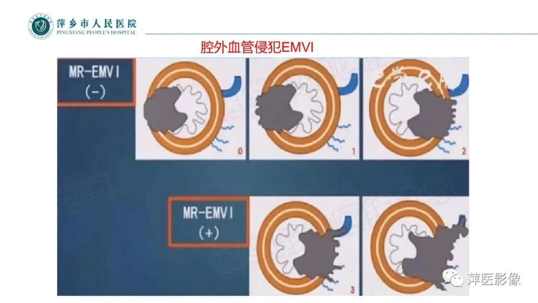 影像PPT - 【PPT】直肠癌MR分期-21