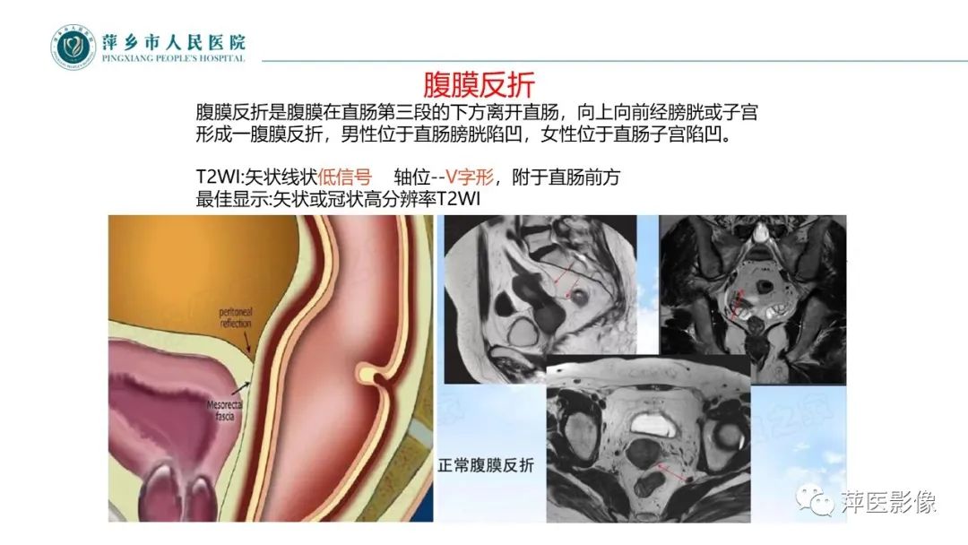 影像PPT - 【PPT】直肠癌MR分期-23