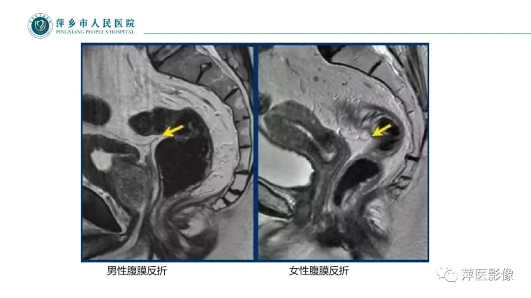 影像PPT - 【PPT】直肠癌MR分期-24