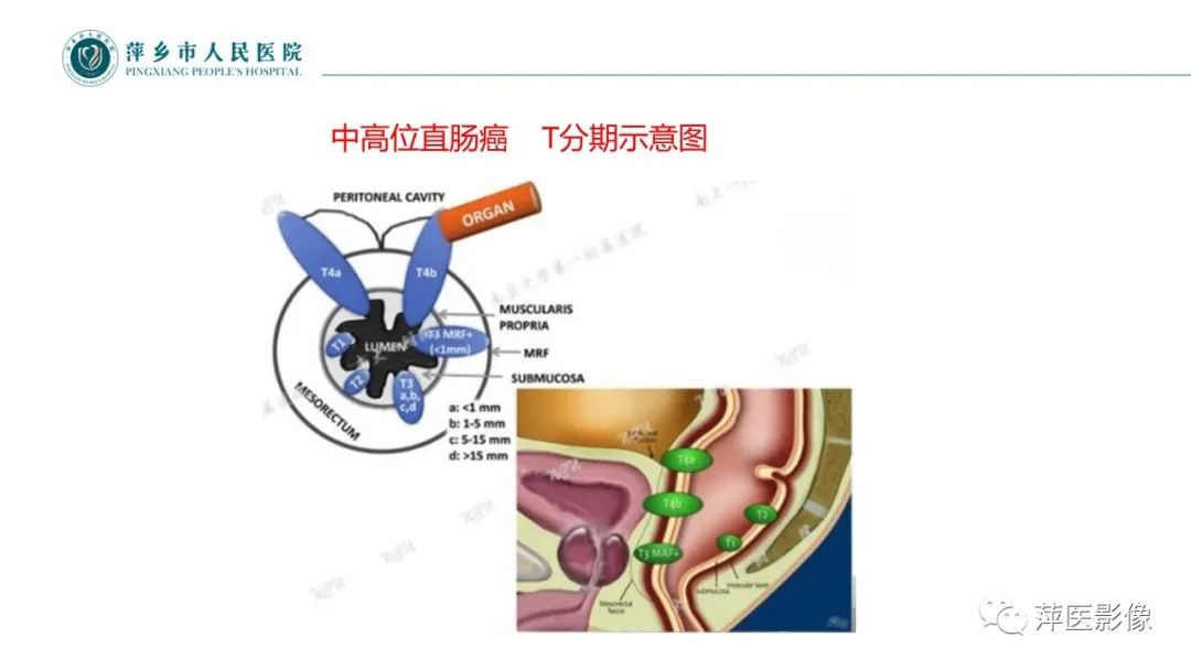 影像PPT - 【PPT】直肠癌MR分期-31