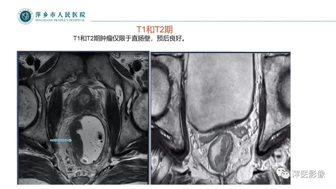 影像PPT - 【PPT】直肠癌MR分期-32