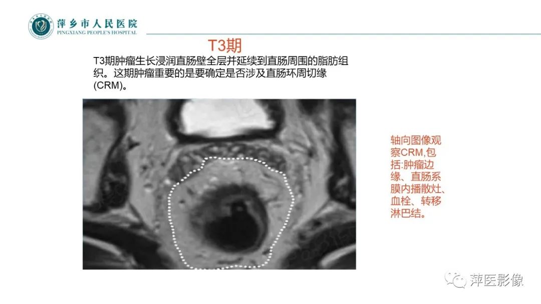 影像PPT - 【PPT】直肠癌MR分期-33