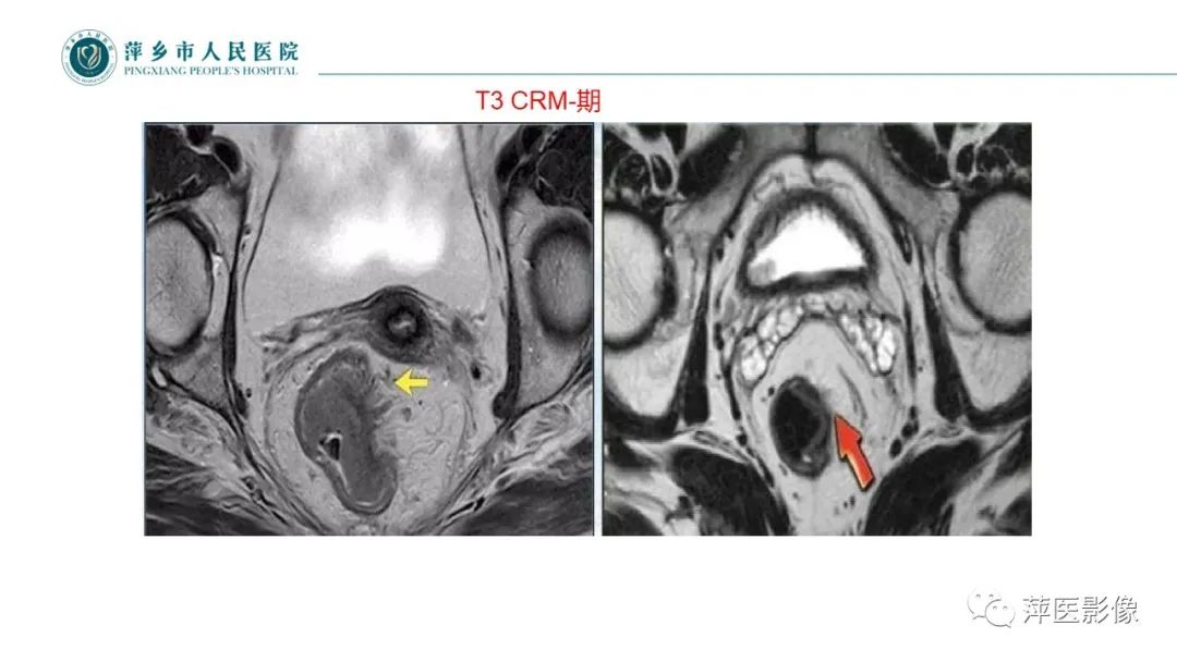 影像PPT - 【PPT】直肠癌MR分期-34