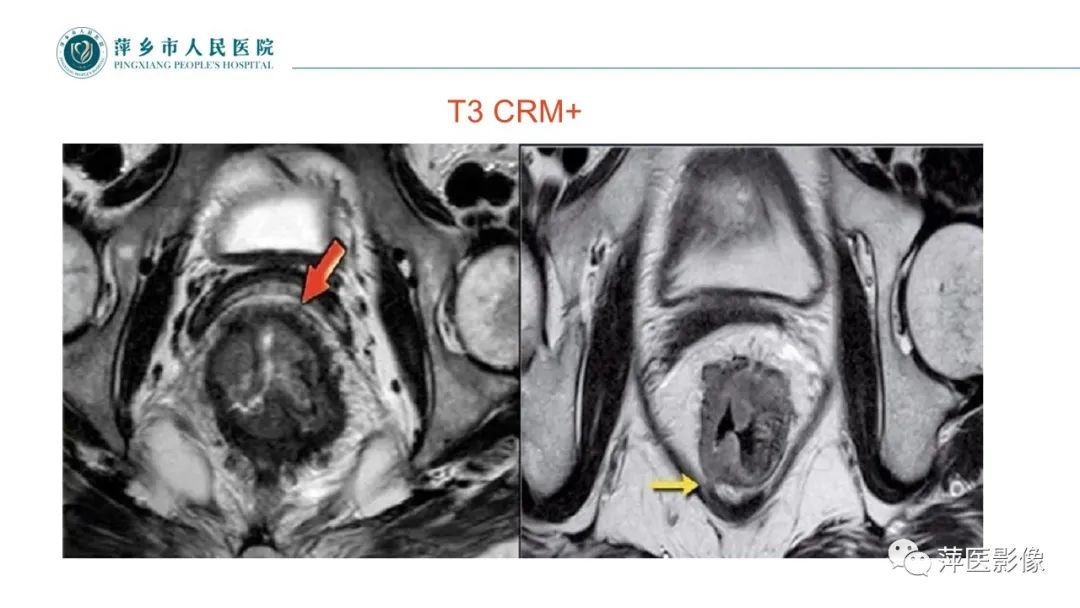 影像PPT - 【PPT】直肠癌MR分期-35