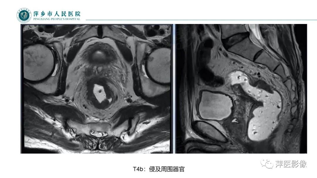 影像PPT - 【PPT】直肠癌MR分期-37