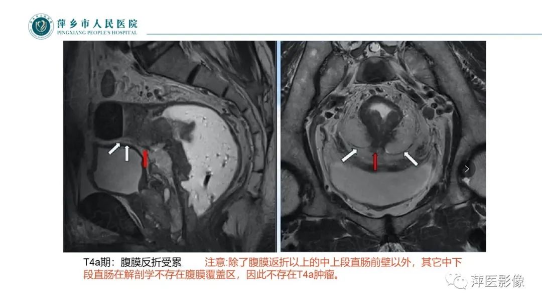 影像PPT - 【PPT】直肠癌MR分期-36