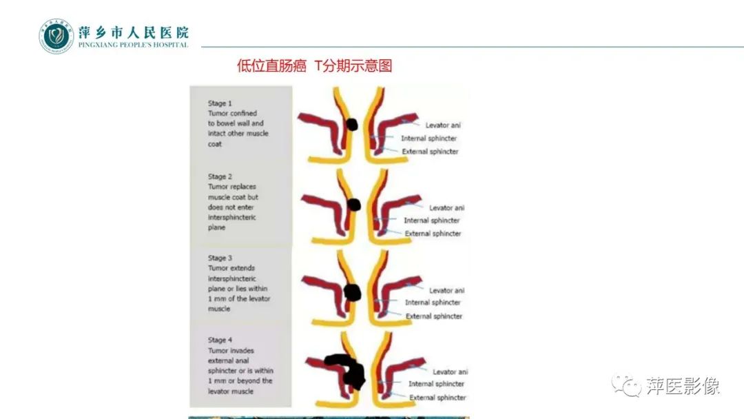 影像PPT - 【PPT】直肠癌MR分期-39