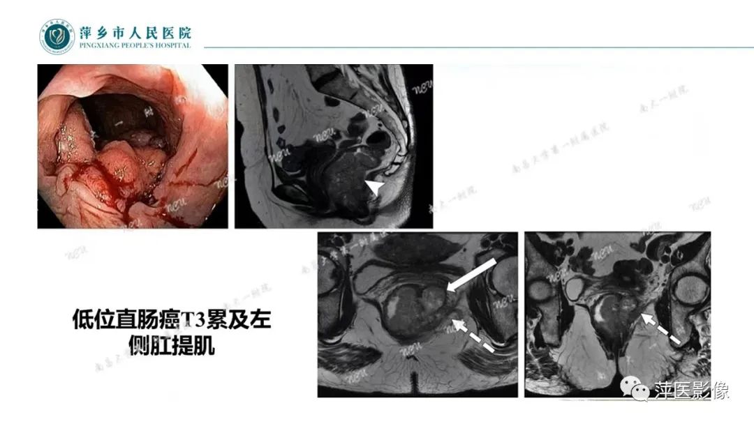 影像PPT - 【PPT】直肠癌MR分期-40