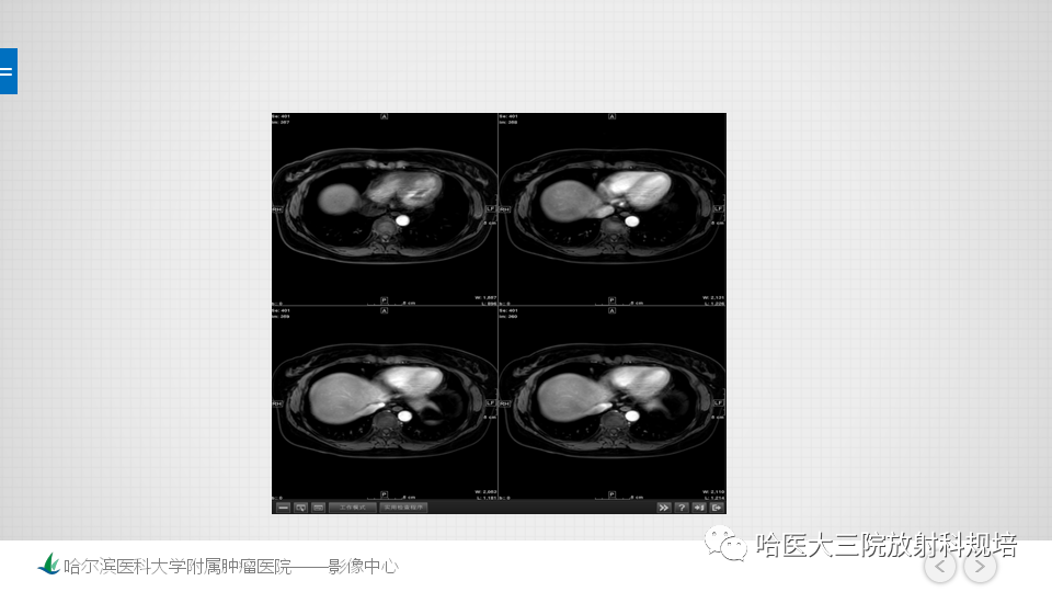 影像PPT - 【PPT】肝脏扫描规范及常见问题-10