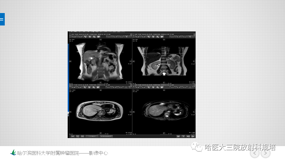 影像PPT - 【PPT】肝脏扫描规范及常见问题-12