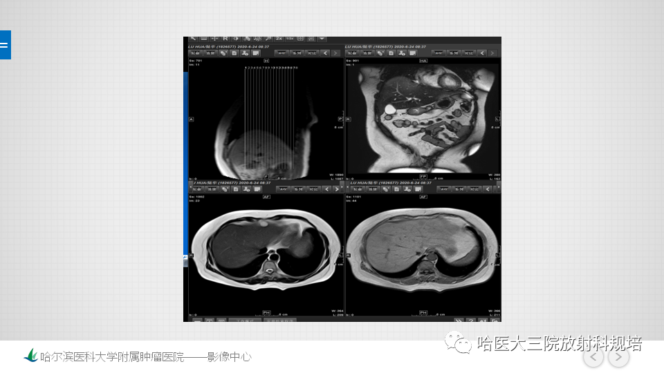 影像PPT - 【PPT】肝脏扫描规范及常见问题-14