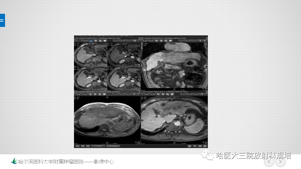 影像PPT - 【PPT】肝脏扫描规范及常见问题-19