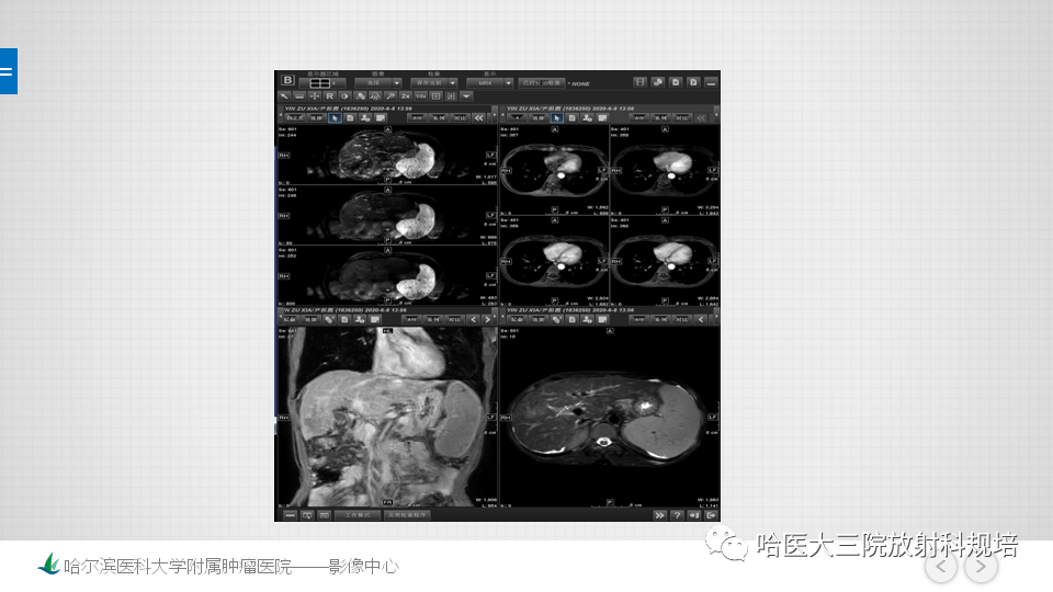 影像PPT - 【PPT】肝脏扫描规范及常见问题-21