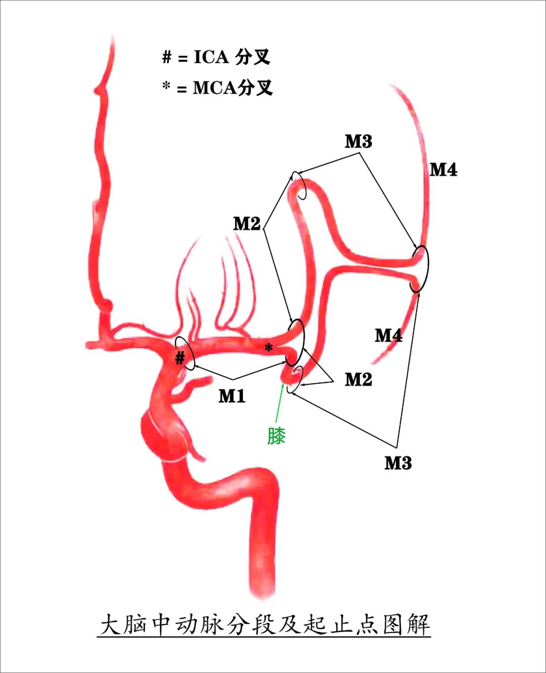 影像PPT - 大脑中动脉解剖-3 影像PPT - 大脑中动脉解剖-3