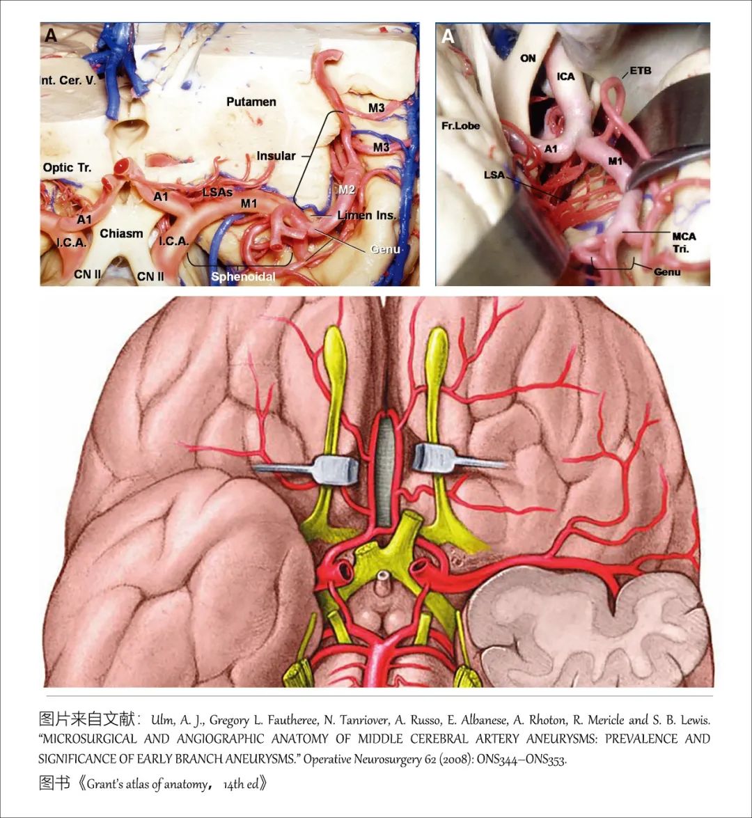 影像PPT - 大脑中动脉解剖-4 影像PPT - 大脑中动脉解剖-4