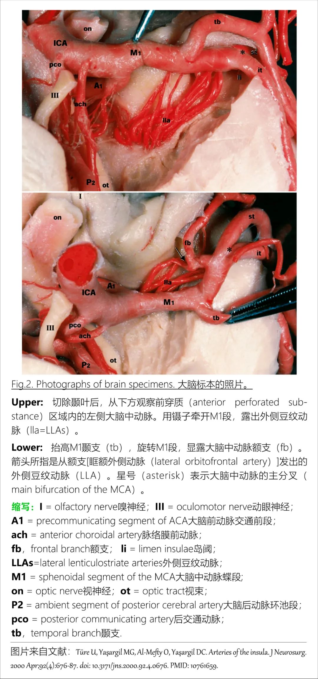 影像PPT - 大脑中动脉解剖-7 影像PPT - 大脑中动脉解剖-7
