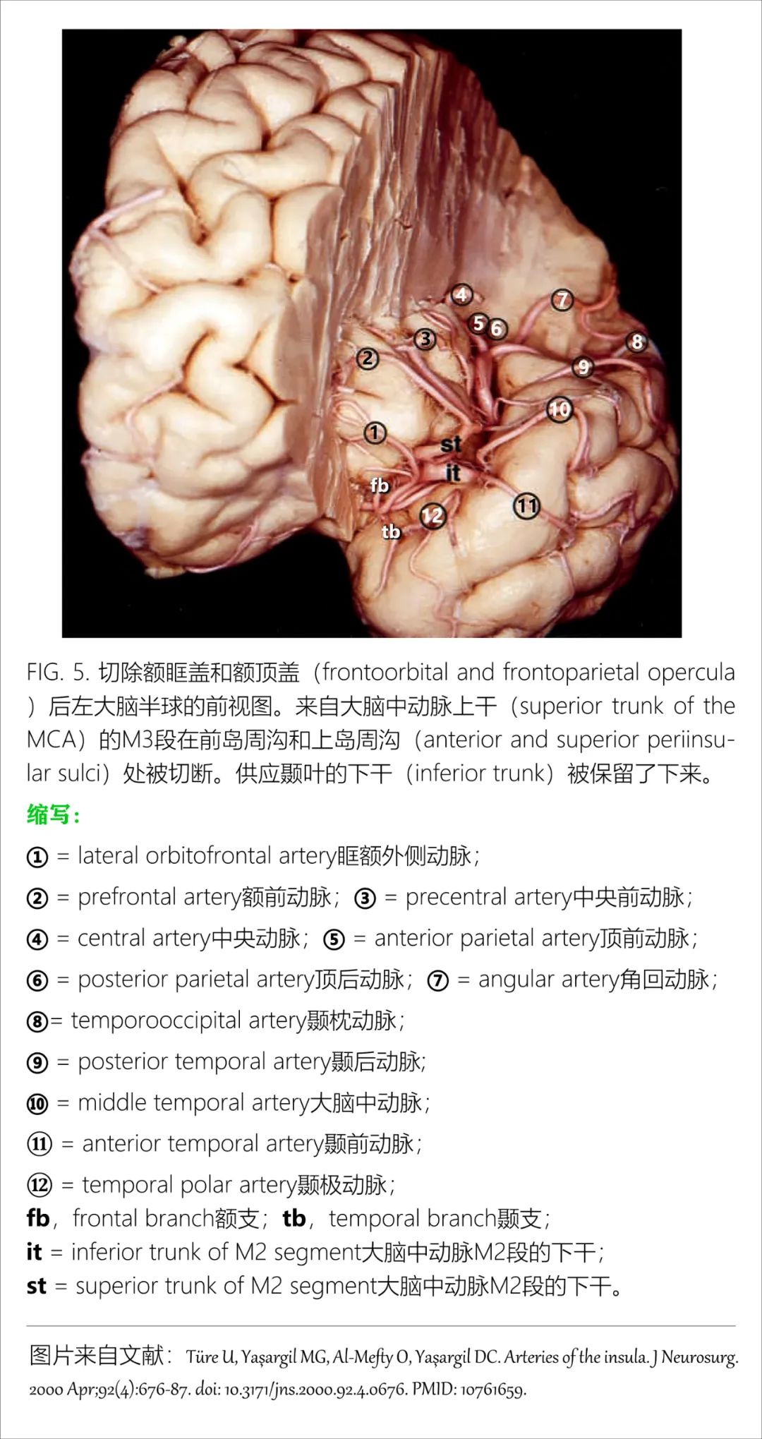 影像PPT - 大脑中动脉解剖-15 影像PPT - 大脑中动脉解剖-15